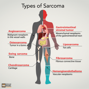 sarcoma-types.png